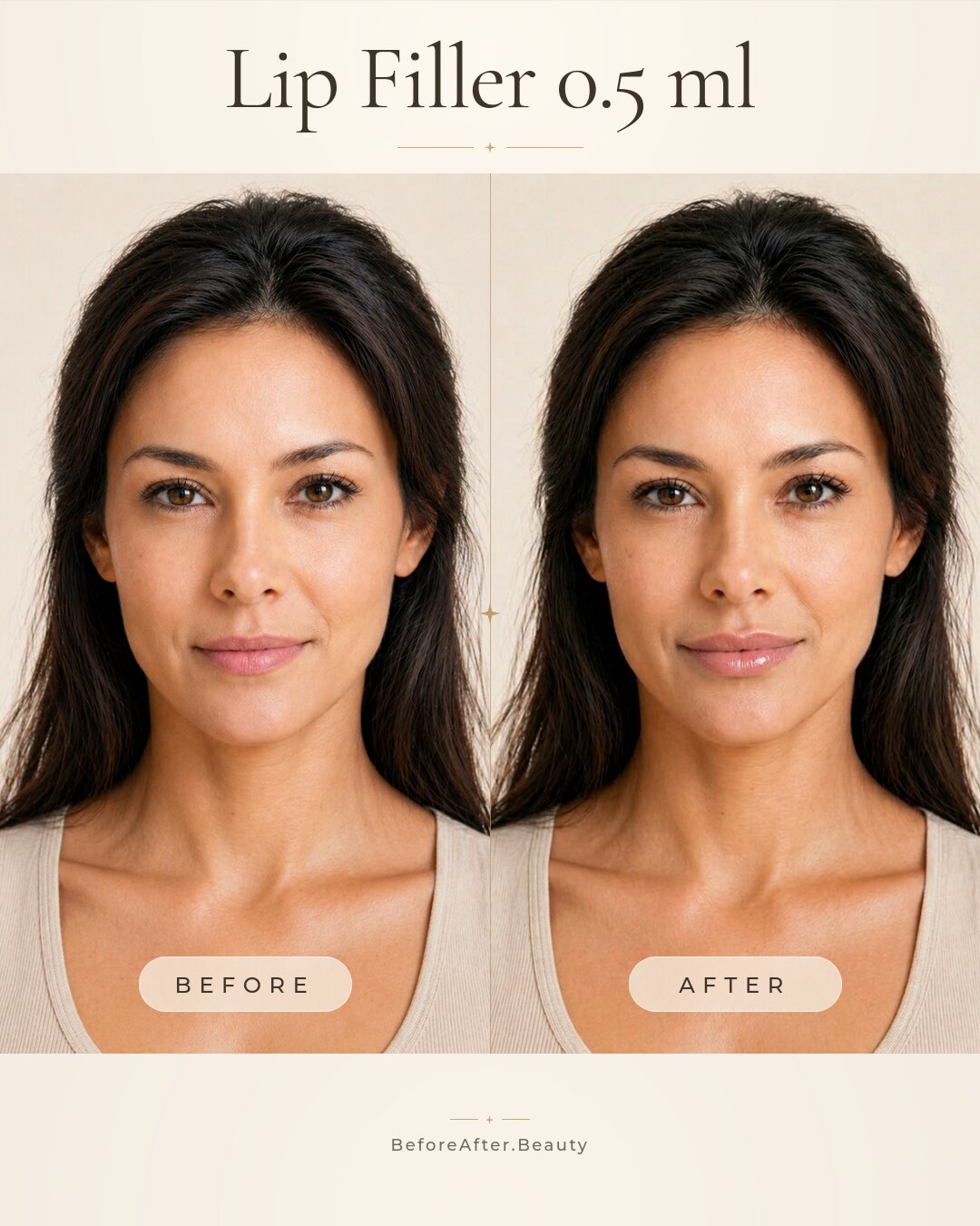 Lip filler 0.5 ml injection