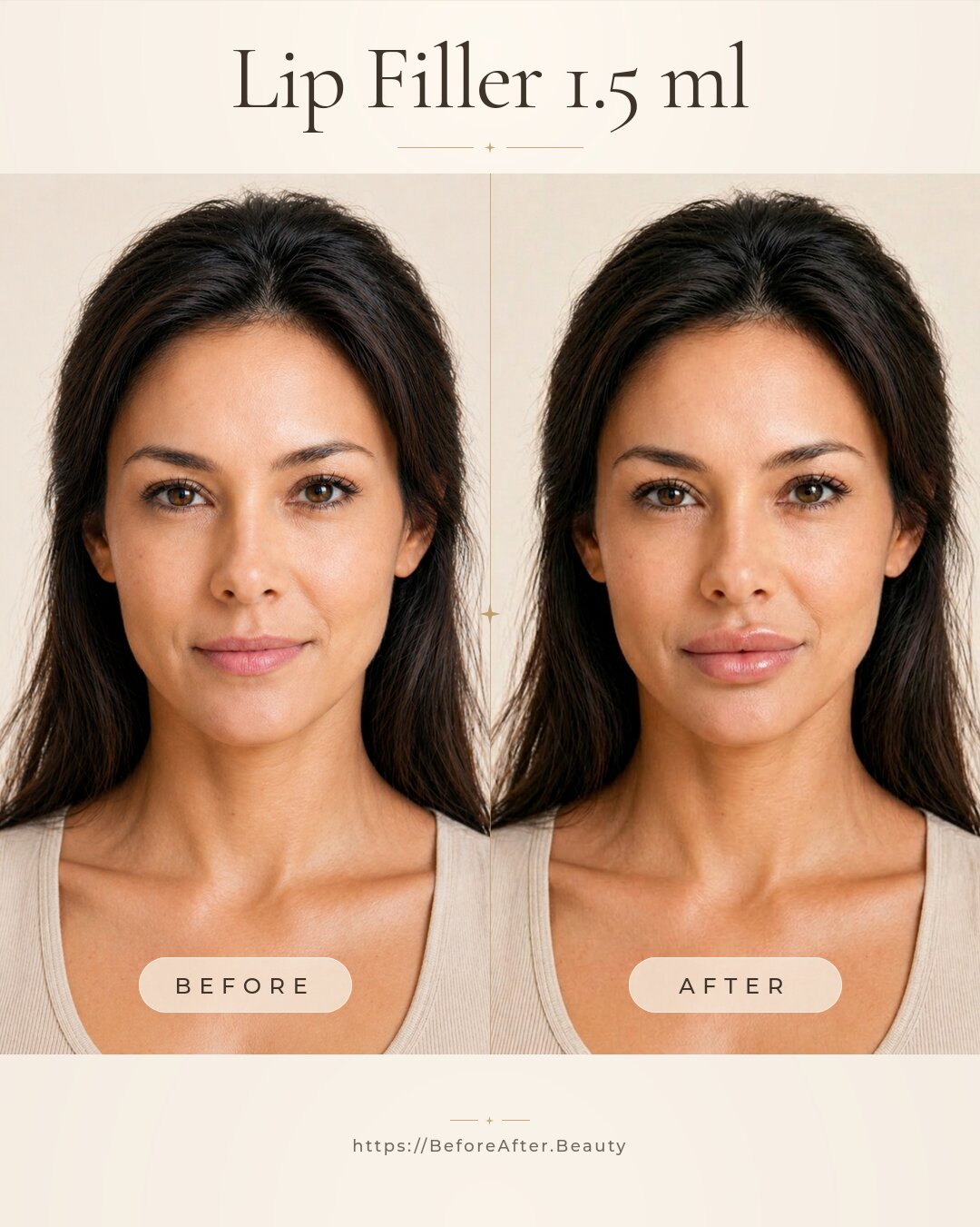 Lip filler 1.5 ml injection